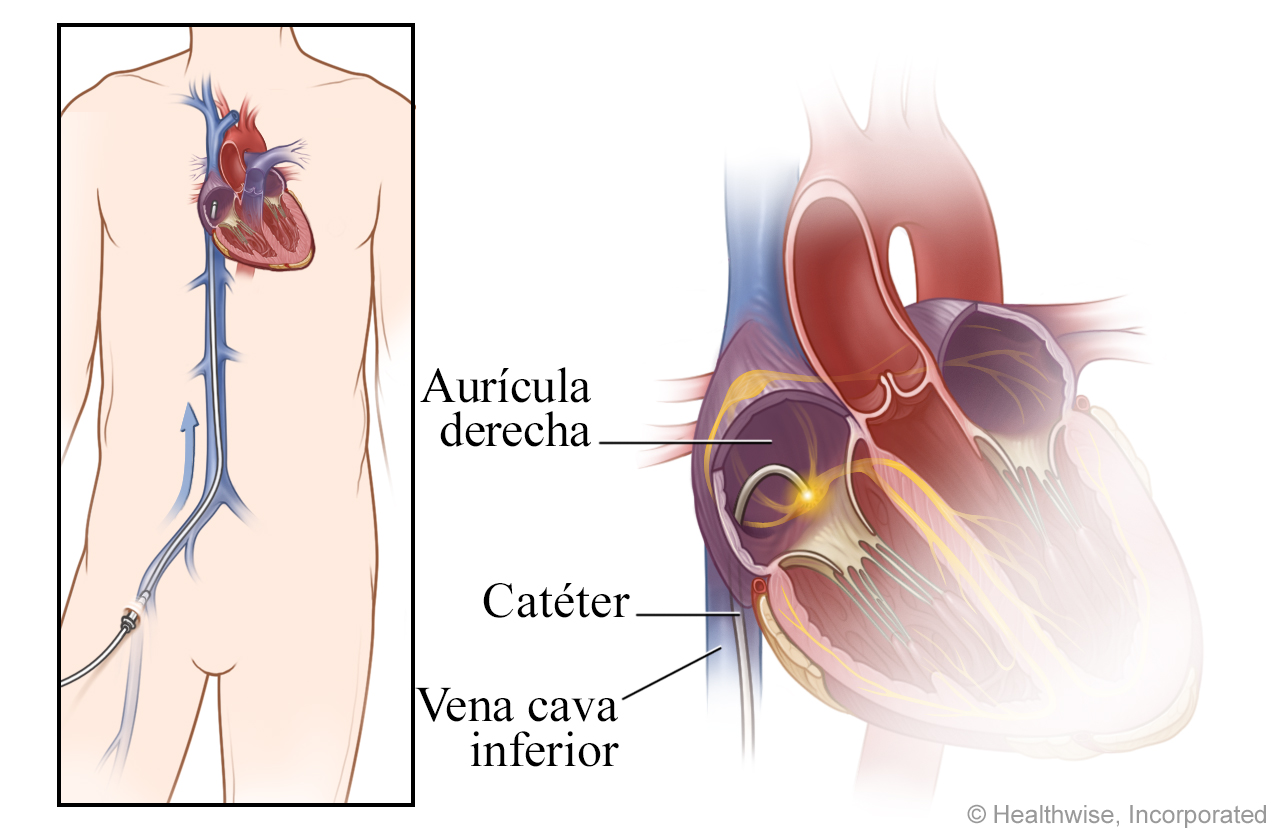 Vista del catéter de la ingle al corazón, con detalle del catéter dentro de la aurícula