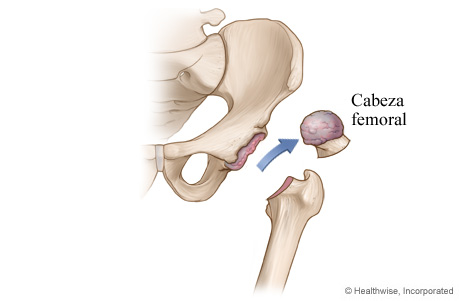 Artroplastia de la cadera: Paso 1 - Se extraen el cartílago y el hueso dañados