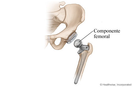 Artroplastia de cadera: Paso 3 - Se coloca el componente femoral