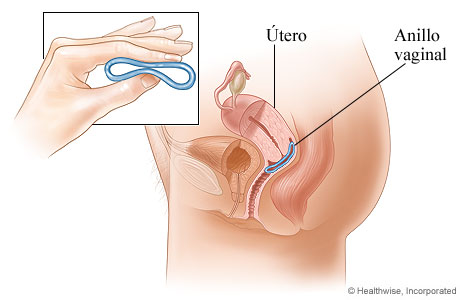 Anillo vaginal como método anticonceptivo