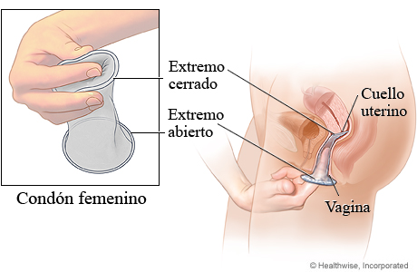 Condón femenino como método anticonceptivo