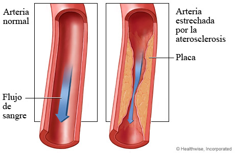 Arteria coronaria y flujo de sangre normales y arteria estrechada por la aterosclerosis
