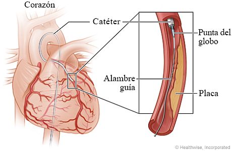 El alambre guía y la punta del globo en una arteria coronaria estrechada