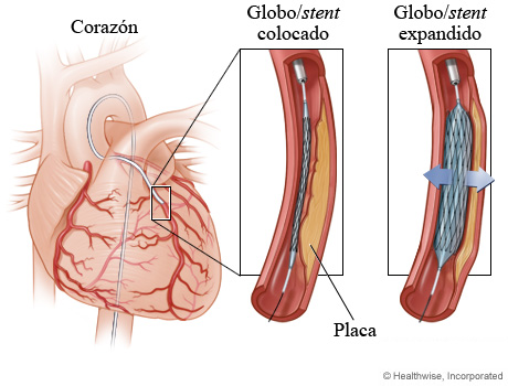 El globo y el stent colocados y expandidos