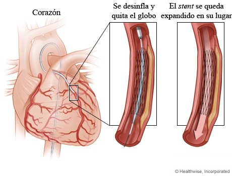 Globo desinflado que deja un stent expandido en su lugar