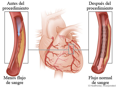 Menor flujo de sangre a causa de una arteria estrechada antes de la angioplastia comparado con flujo normal de sangre después de la angioplastia