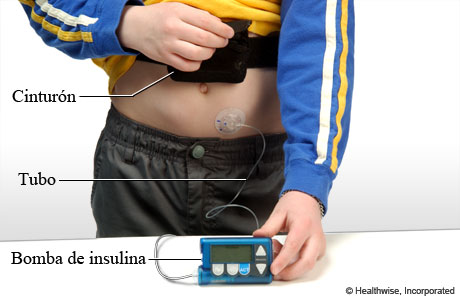 Bomba de insulina, sensor y cinturón