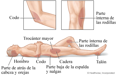 Zonas donde comúnmente se forman lesiones por presión