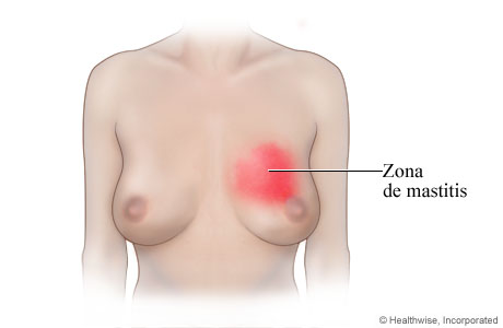 Imagen de mastitis (inflamación del seno)
