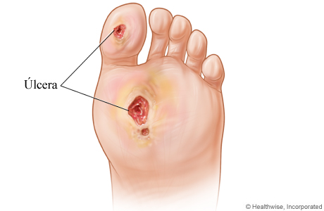 Úlceras del pie diabético