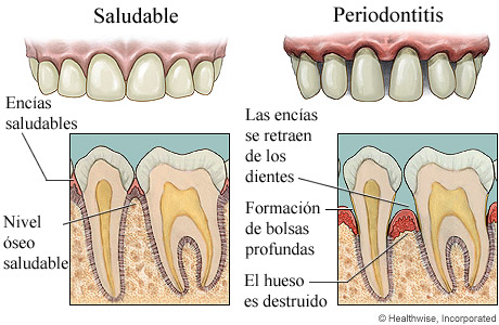 Encías saludables y enfermedad avanzada de las encías, con detalle de ambas