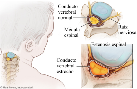 Imagen de estenosis espinal cervical