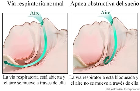 Una vía respiratoria normal y una obstruida (apnea obstructiva del sueño)