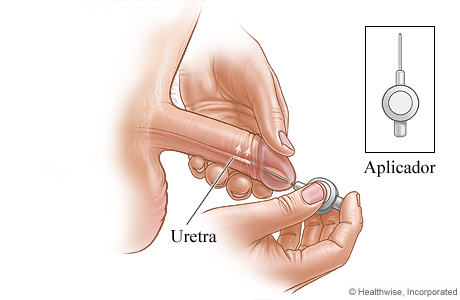 Imagen de cómo aplicar terapia transuretral para problemas de erección