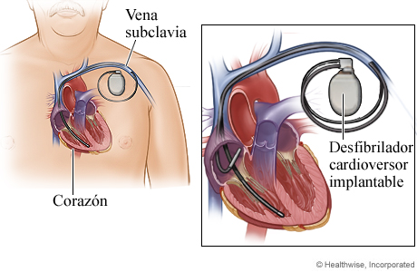 Ubicación del desfibrilador cardioversor implantable y conexión a las cavidades del corazón