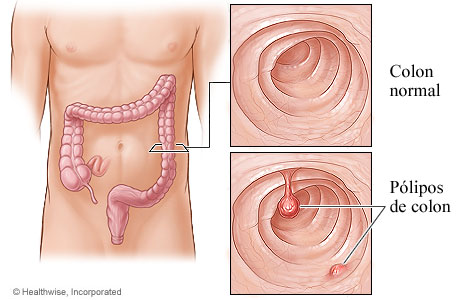 Pólipos de colon y ubicación del colon