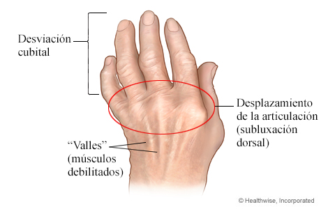 Imagen de la artritis reumatoide en la mano