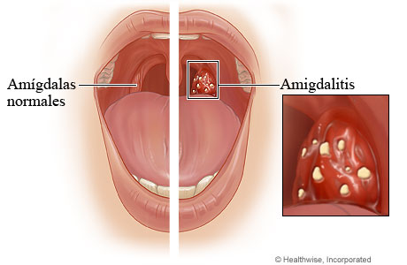 Amigdalitis comparada con amígdalas normales