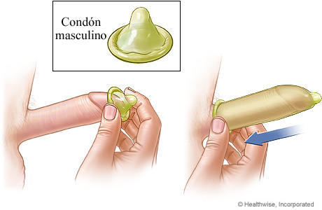 Condón masculino como método anticonceptivo