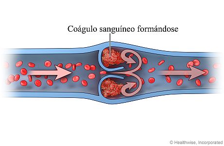 Formación de un coágulo de sangre