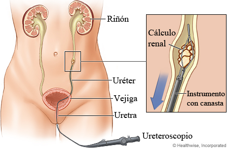 Cómo se usa un ureteroscopio para extraer un cálculo renal