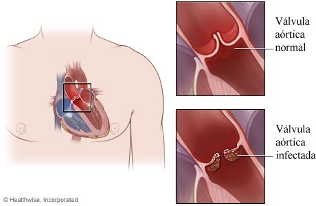 El corazón, con detalle de una válvula aórtica normal y una válvula aórtica infectada