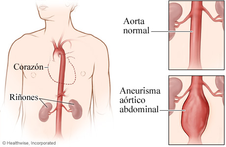 Una aorta normal y un aneurisma aórtico abdominal