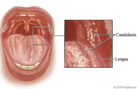 Candidiasis oral, con un primer plano de candidiasis en la lengua y en la parte interior de la mejilla