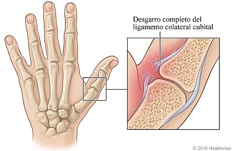 Vista del esqueleto de la mano, con detalle del desgarro completo del ligamento colateral cubital del pulgar