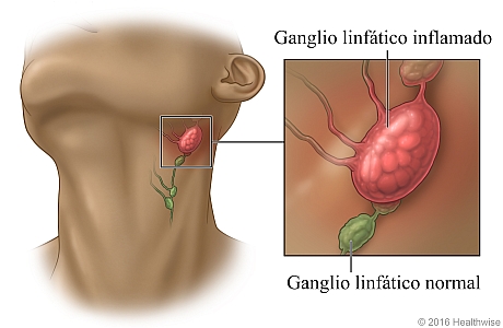 Ubicación de los ganglios linfáticos en el cuello, con detalle de un ganglio linfático inflamado y un ganglio linfático normal