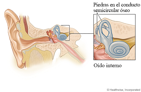 Anatomía del oído, con detalle de piedras en el conducto semicircular óseo