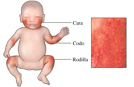 Imagen de eccema (dermatitis atópica) en un bebé