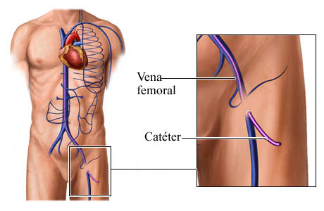 Cómo se coloca un catéter en la vena femoral