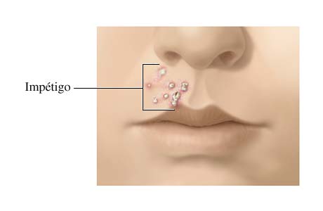 Llagas de impétigo entre el labio superior y la nariz