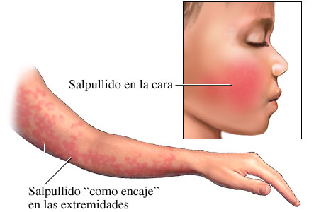 Imagen del salpullido de eritema infeccioso (quinta enfermedad) en la cara y el brazo